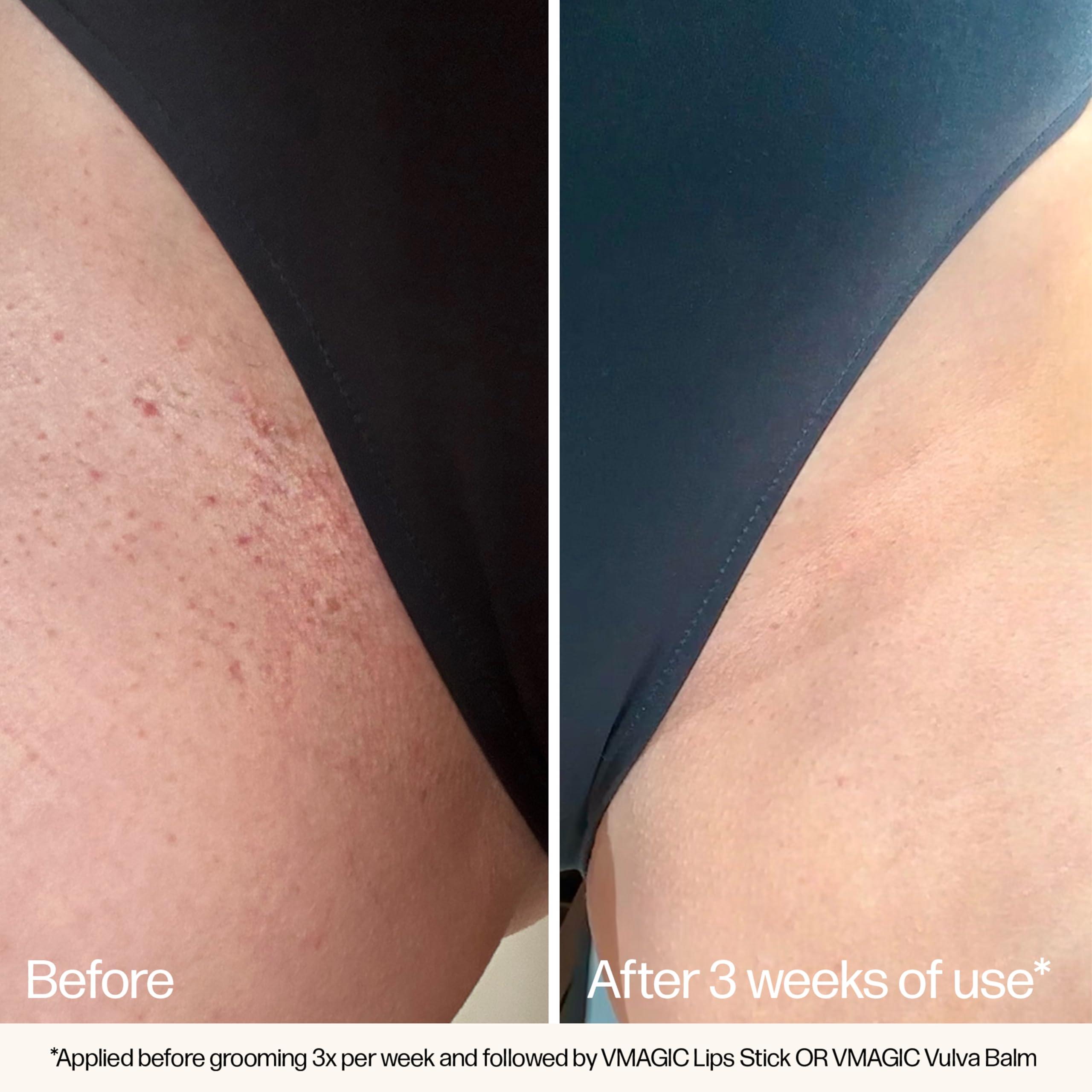 Medicine Mamas VMAGIC by Medicine Mama Grooming Polish All-Natural Exfoliating Sugar Scrub Preps Skin & Body for Grooming, Helps Prevent Ingrown Hairs Brazilian Wax & Bikini Shave Aftercare 4.5 oz