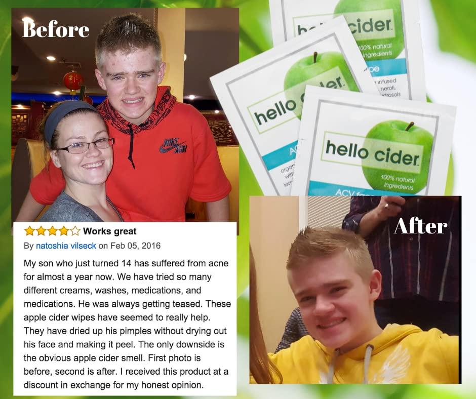 Hello Cider Apple Cider Vinegar Acne Face Wipes-Organic TeaTree, Rose, Chamomile, Witch Hazel.Oil free. Reduce Blemish & Acne. Tone,Restore, Sooth, Balance pH. Dry, Normal, Sensitive Skin. 25ct. USA Hello Cider