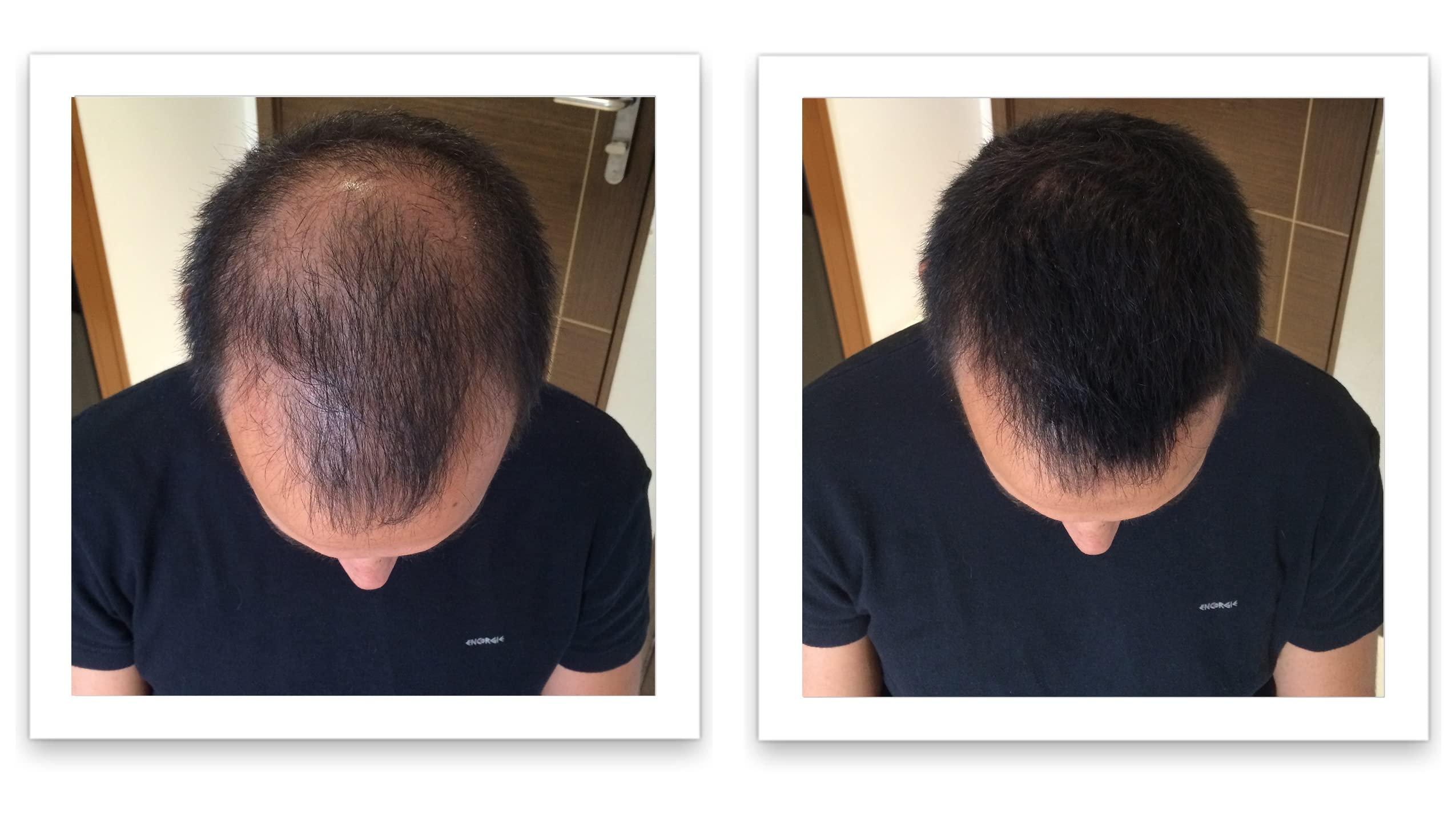 Caboki Caboki Hair Loss Concealer, All-Natural Hair Building Fiber. Make Thin Hair Look 10X Fuller Instantly. Eliminate the Appearance of Bald Spot and Thinning Hair (30G, 90-Day Supply). Black