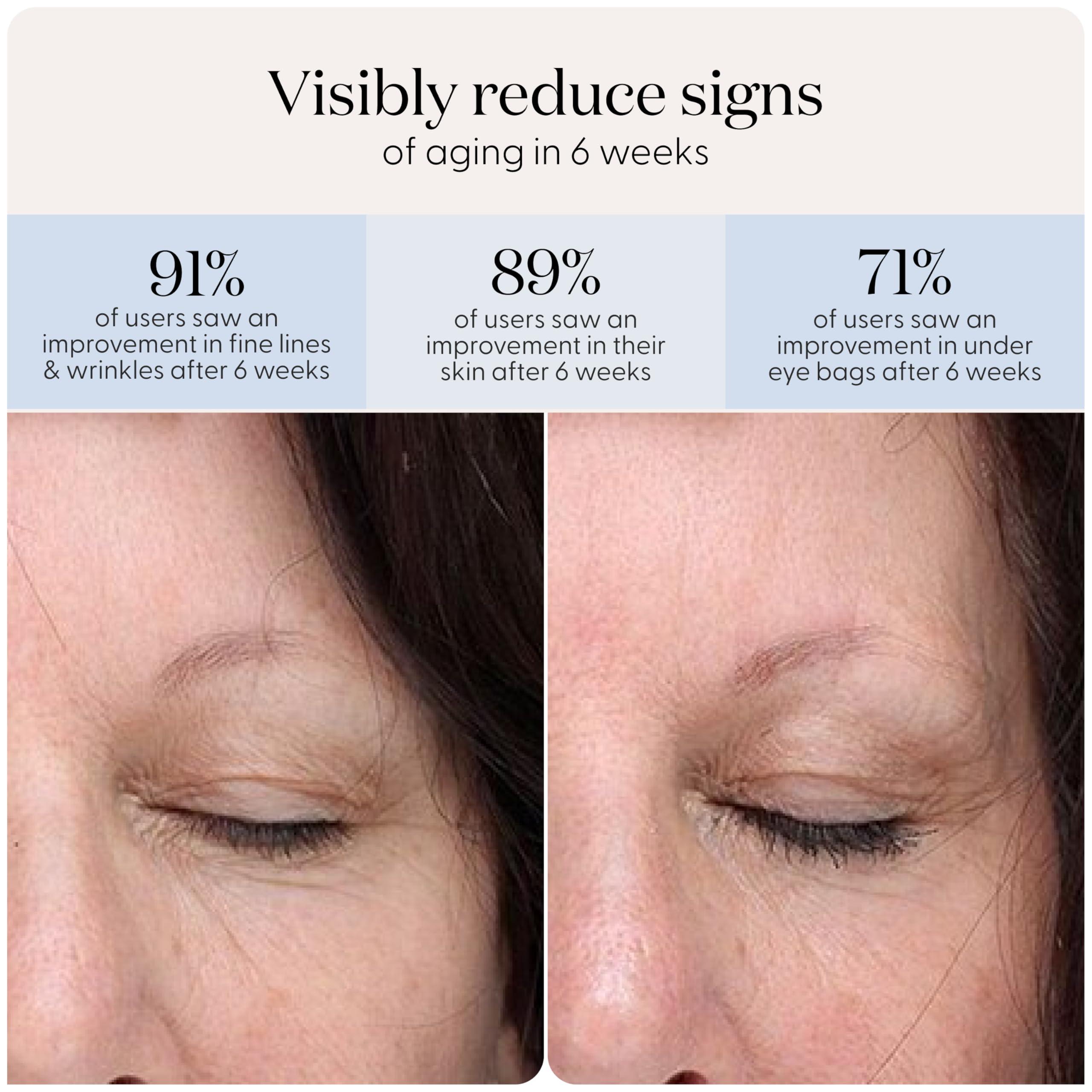 SMOOTHSKIN SmoothSkin Under-Eye Red Light Therapy Device, LED Eye Patches with 24 Hydrocolloids, for Dark Circles, Wrinkles & Puffiness