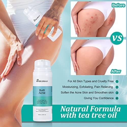 SIRUIMAO SIRUIMAO Butt Acne Clearing Treatment (3.5OZ), Bum Acne Treatment for Clearing Acne, Pimples, Blackheads, Zits and Razor Bumps for the Buttocks and Thigh Area (2 bottles)