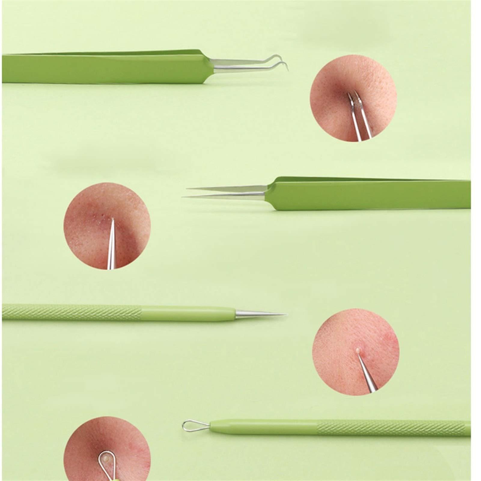 XINGTUO Pimple Popper Tool Kit 5PCS Blackhead Remover Kit Pimple Comedone Extractor Tool Set Treatment for Blemish, Zit, Acne Whitehead Tweezers Kit with 5X Magnifying Mirror Blackhead Remover Tools