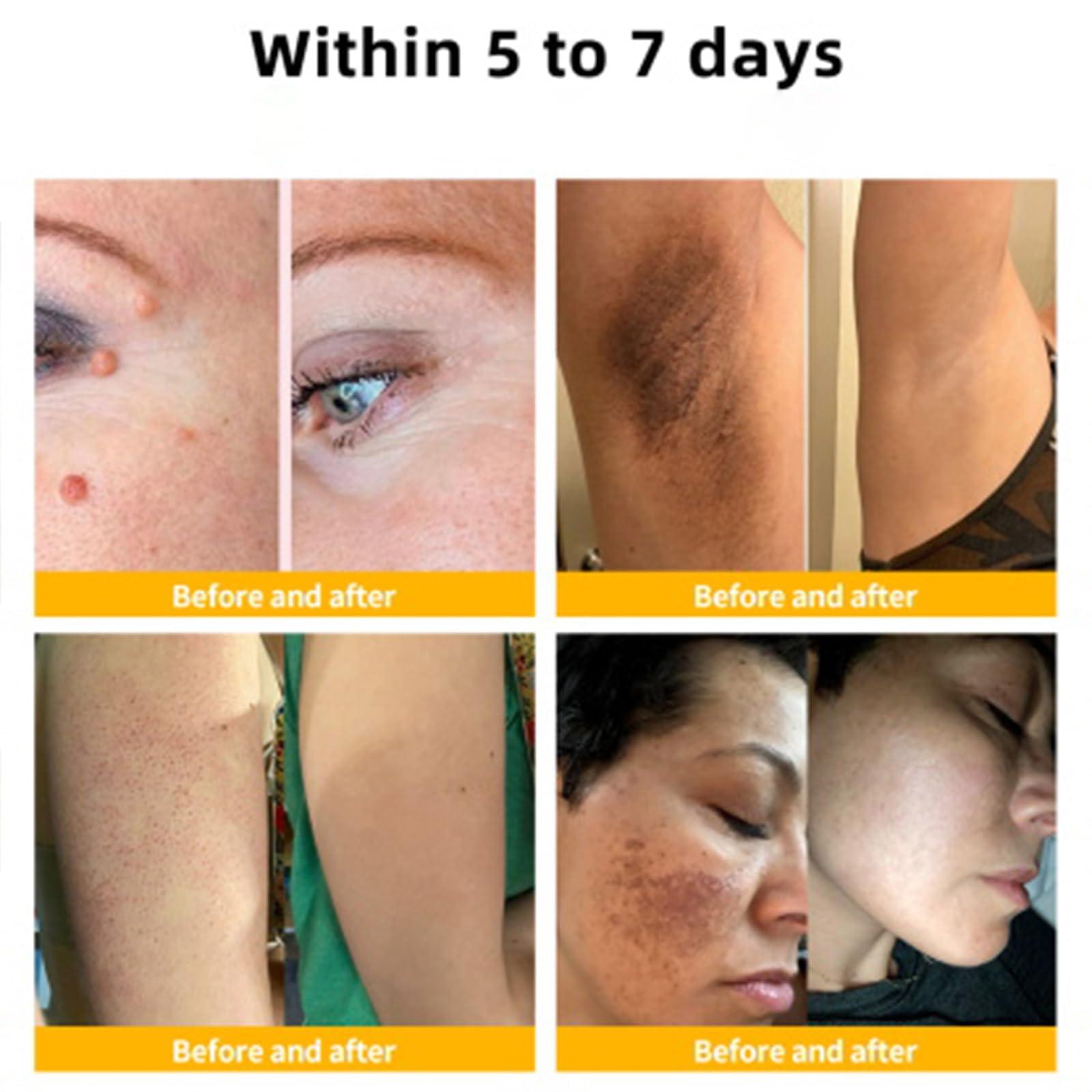 flysmus flysmus Bee venom Removal Marks Cream, Bee Venom Repair Cream, Bee Venom Removal Cream - All Skin Types (4PCS)