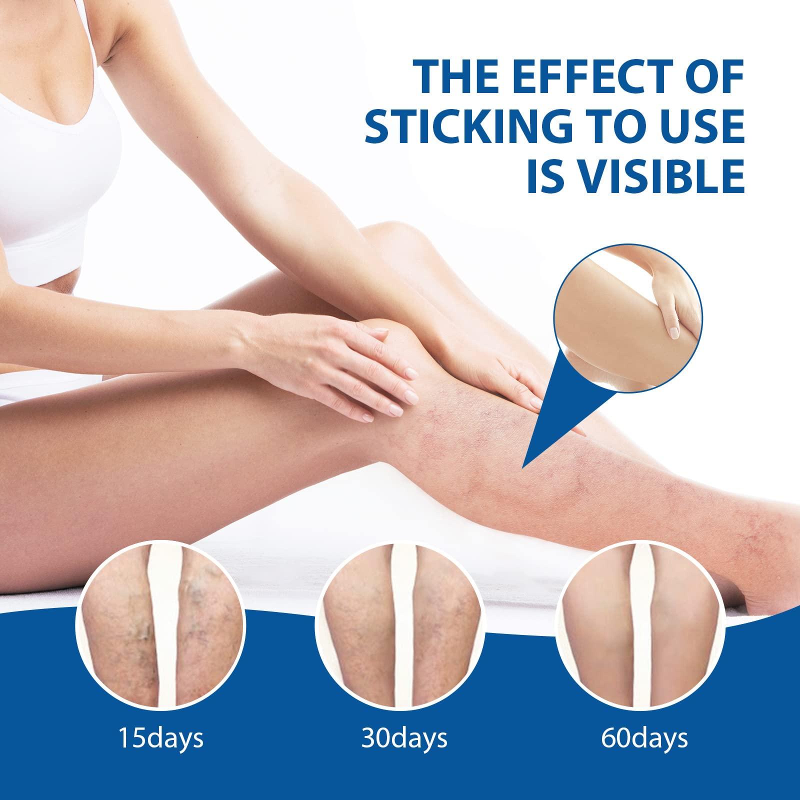 Nosbei Vericose Veins Treatment Blue Light Lazer Treatment Pen, Varicose Veins Blue Light Therapy Set, Blue Light Therapy Pen for Varicose and Spider Veins, Spider Vein Removal Lazer Pen (2cream+1pen)