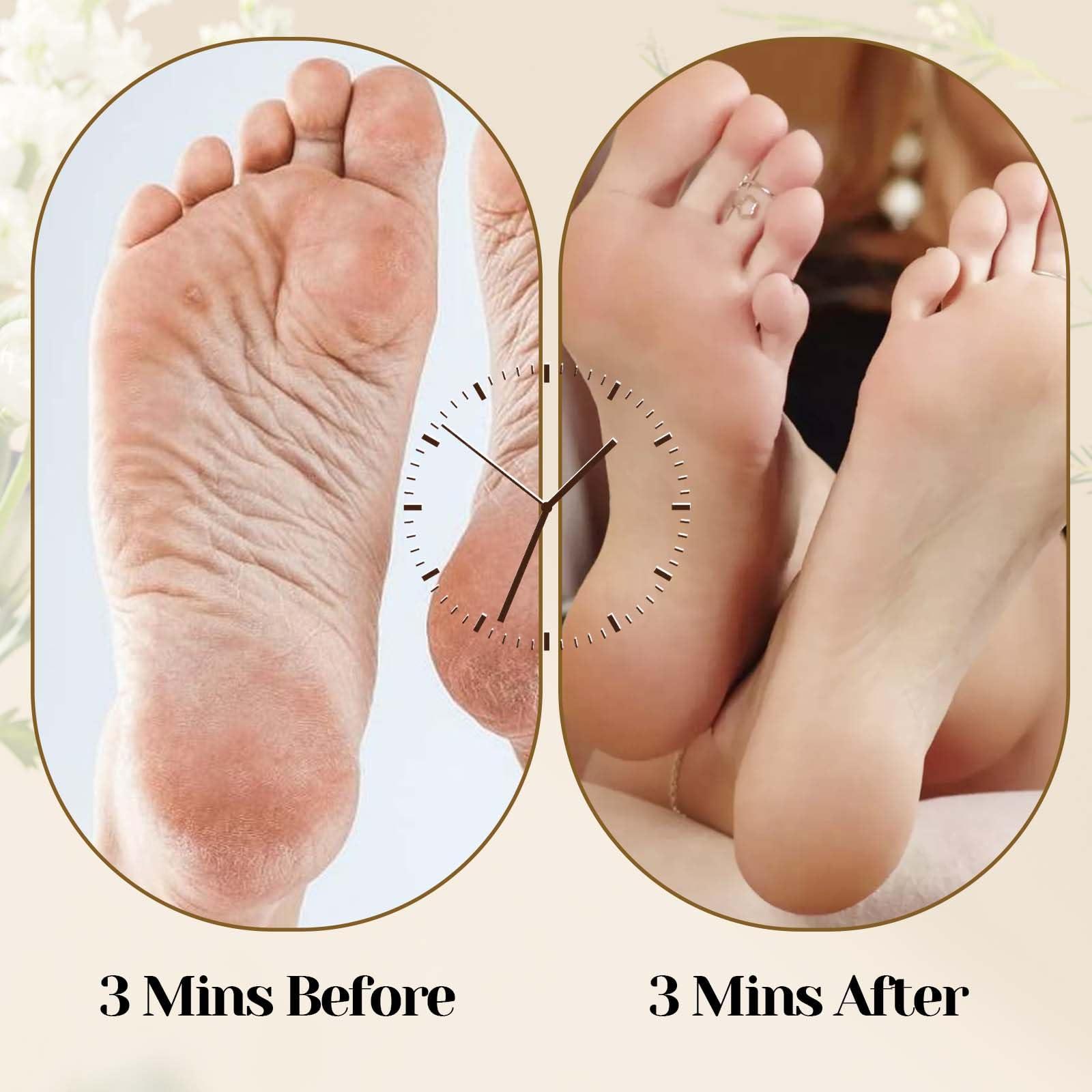 WY LIGHTING LEVEL Callus Remover Foot Scrubber Foot File Foot Care & Foot Exfoliator Foot Rasp Pedicure Tools Pumice Stone for Feet Remove Corn Hard Skin Dead Skin Cracked Heel for Shower Hand Body Foot Scraper Wet Dry