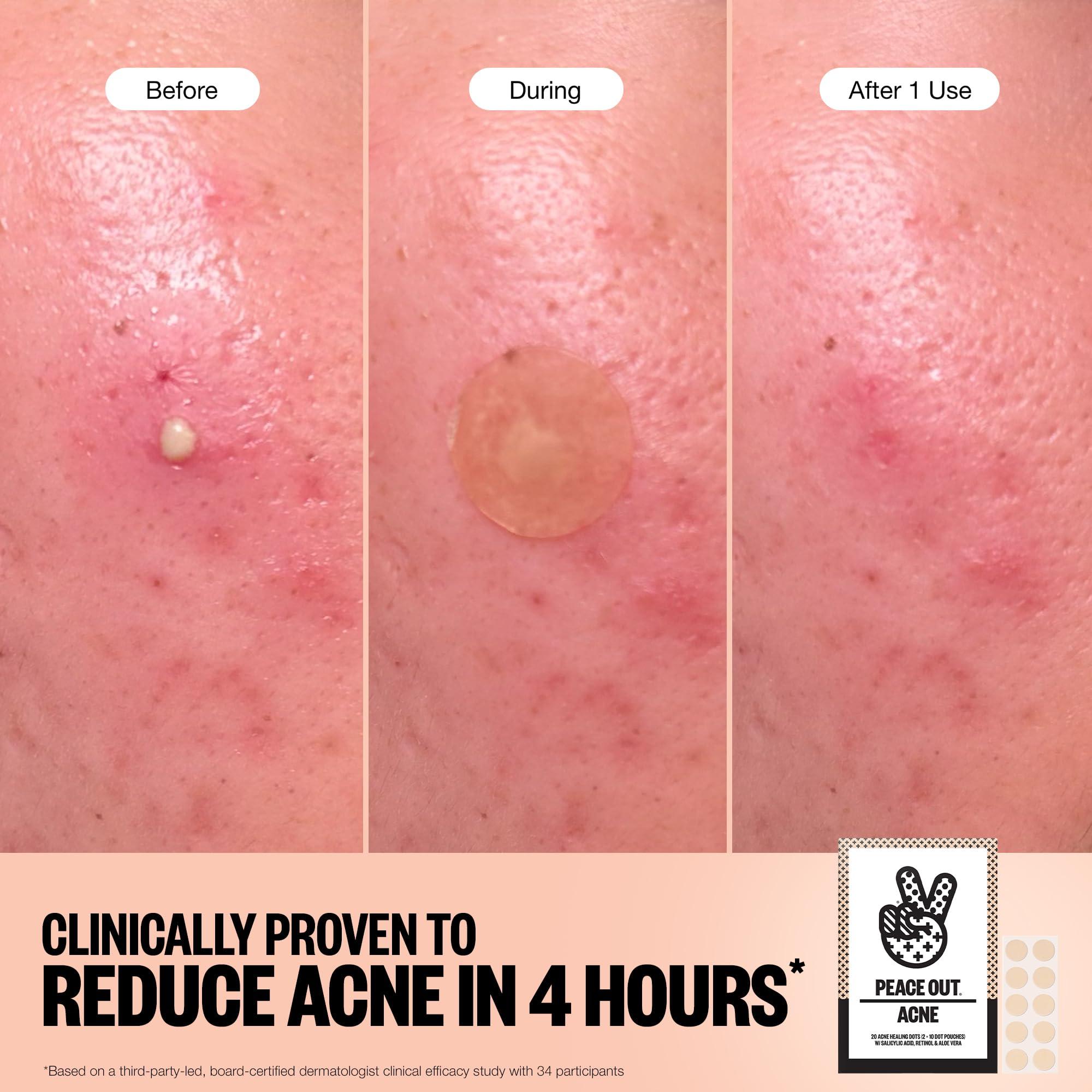 PEACE OUT PEACE OUT Acne Healing Dots Helps Clear Blemishes Overnight, Fast Acting Hydrocolloid Pimple Patches for Breakouts with Salicylic Acid, Retinol and Aloe Vera, Award Winning Skincare Solution 40 Count