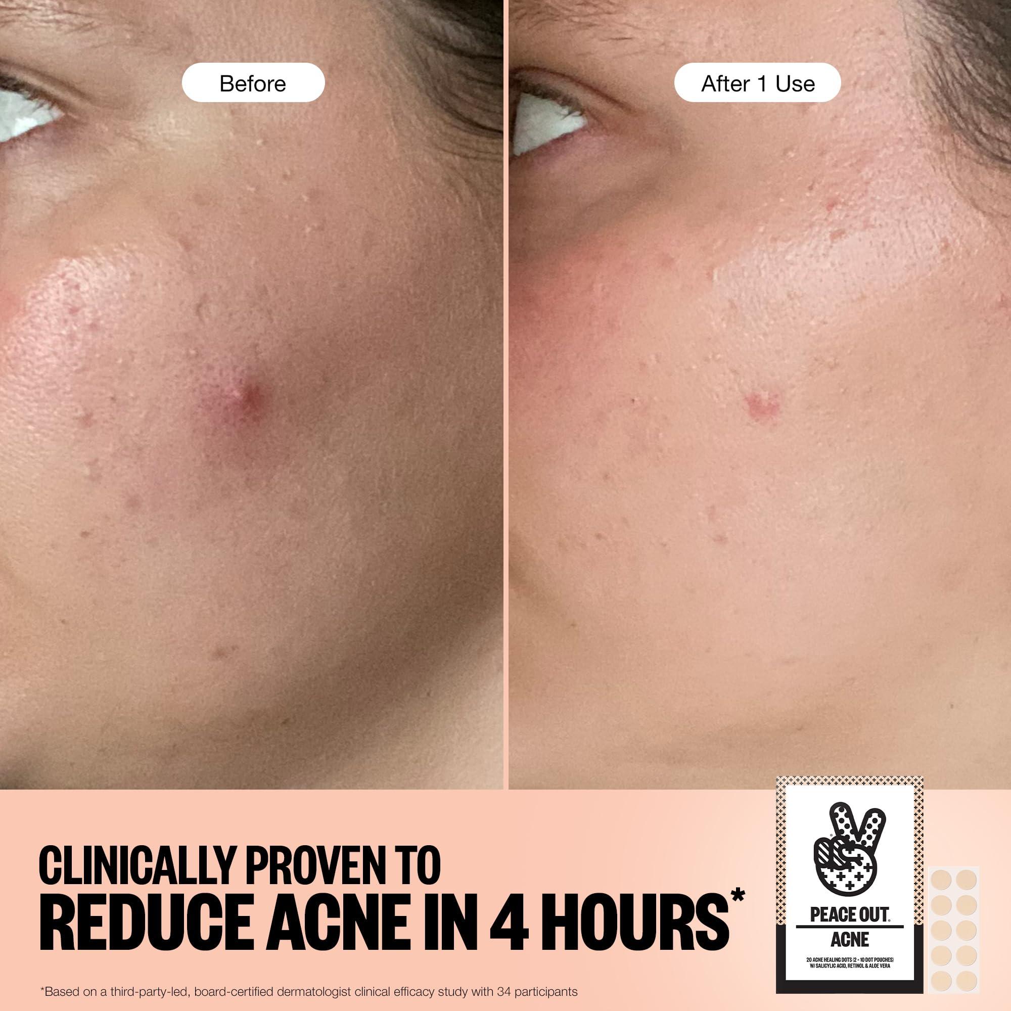 PEACE OUT PEACE OUT Acne Healing Dots Helps Clear Blemishes Overnight, Fast Acting Hydrocolloid Pimple Patches for Breakouts with Salicylic Acid, Retinol and Aloe Vera, Award Winning Skincare Solution 40 Count