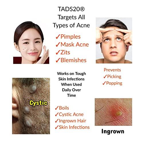 The Acne Dot Store 3pk, [120] Acne Dot Pimple Patches [SMALL SIZE] Cystic Acne Patch, FACE Spot Dots, Zit Sticker, Hydrocolloid Bandages, Blemish Spot Treatment, tads20