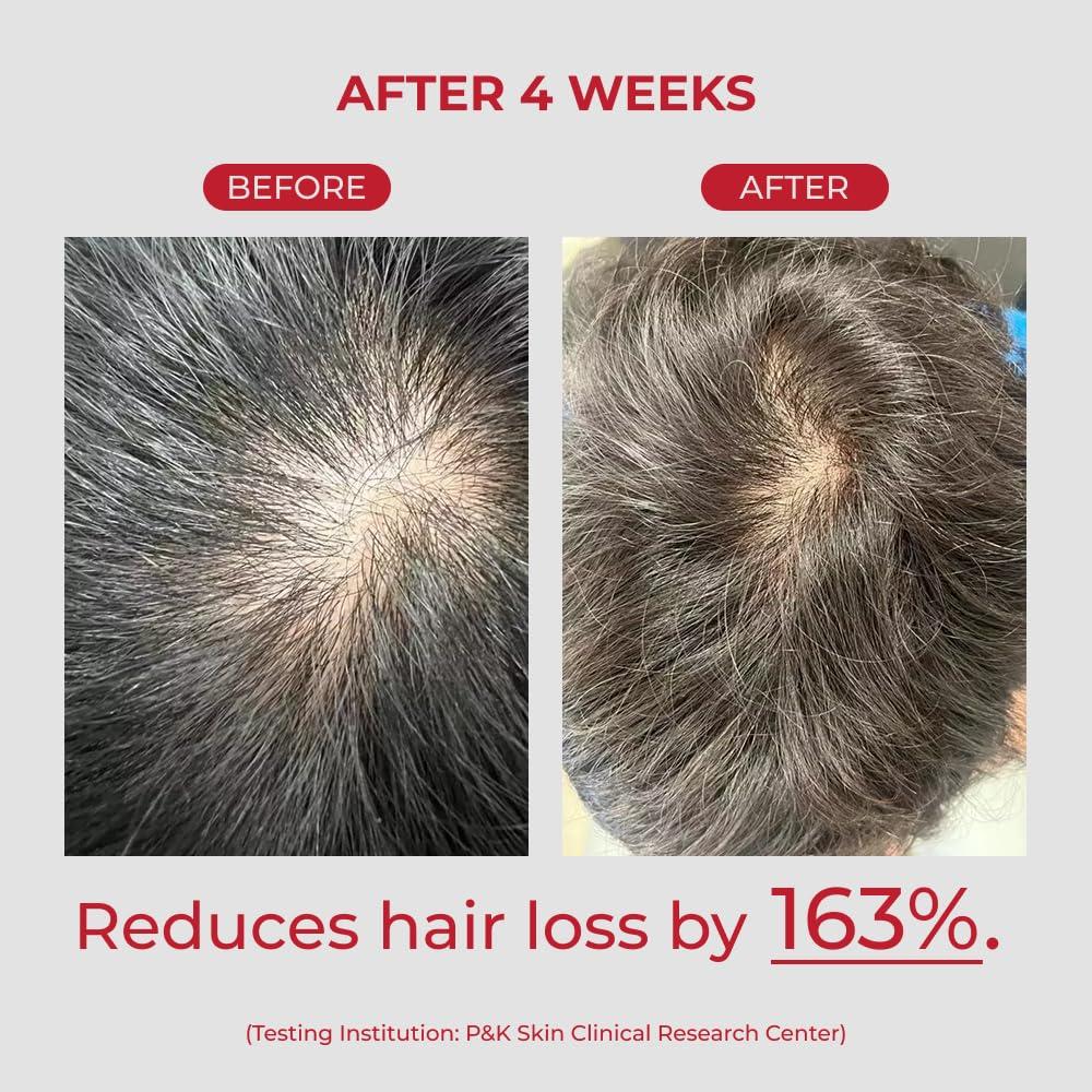 MOEV MOEV ANNURCATIN Shampoo, Biotin Hair Growth Volumizer Korean Anti Hair Loss Shampoo for Women, Build Lift, Natural Sulfate and Paraben-Free Apple Fresh Cleanser, Strengthens Weak Hair 10.14 fl.oz.