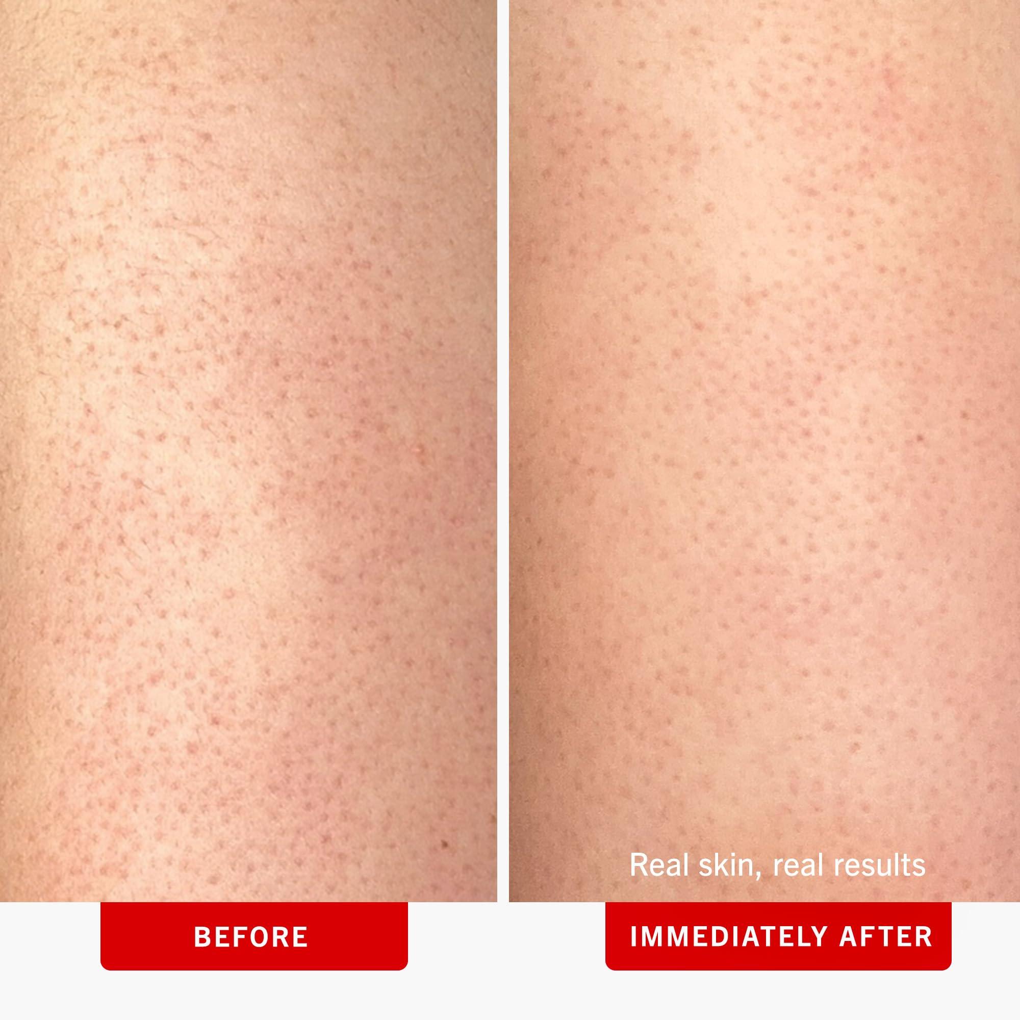 First Aid Beauty First Aid Beauty - KP Bump Eraser Body Scrub with 10% AHA, Keratosis Pilaris Skin Exfoliater with Glycolic and Lactic acids, Helps Reduce Chicken Skin Bumps, Safe for Sensitive Skin, 10 oz