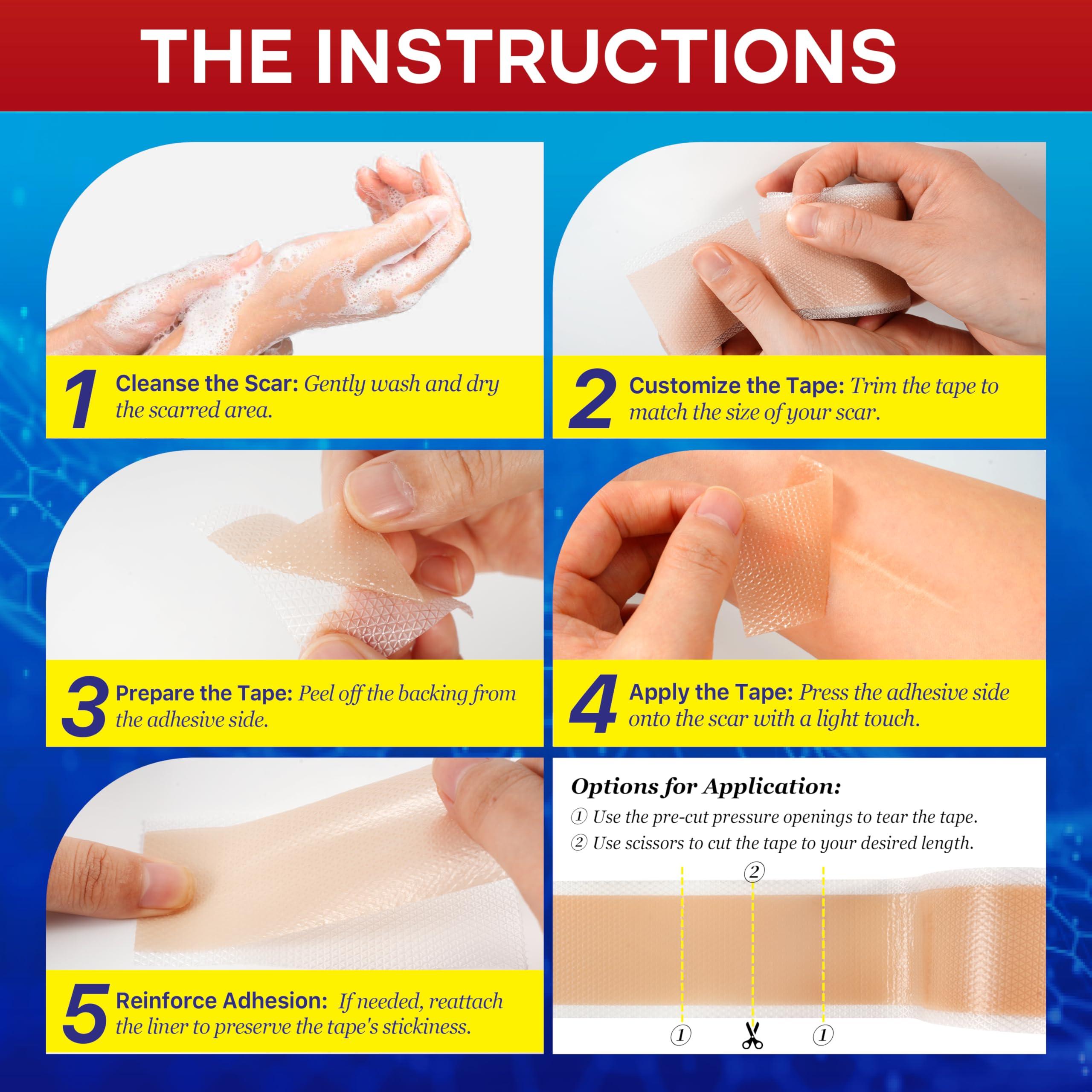 Umaeost 1.6\"x 120\" Medical Silicone Scar tape for Scars: Medical Grade Scar Sheets Reduces the Appearance of Scars from surgical Acne Stitches Burns More