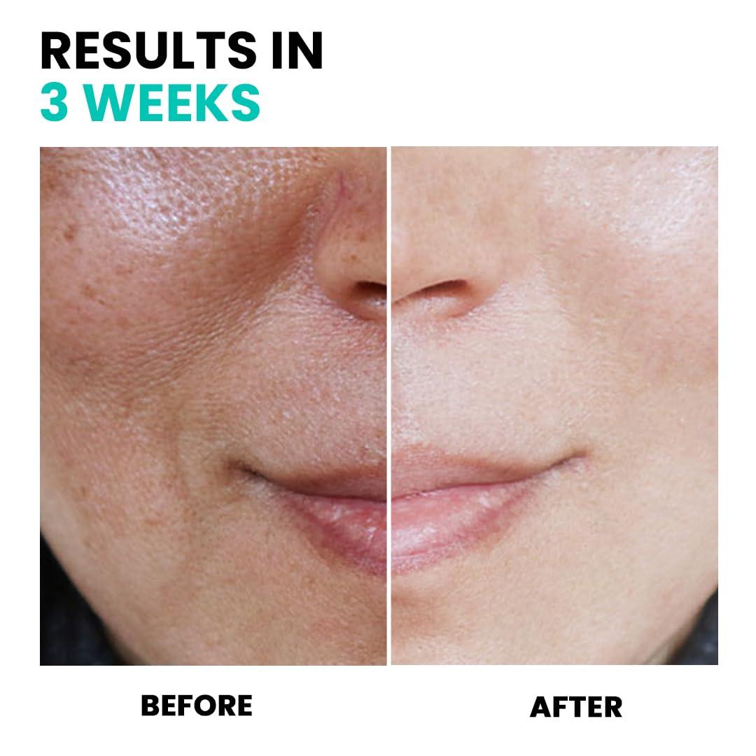 conatural Conatural Anti-Pigmentation Serum 30ml - Dark Spot Corrector Serum for Hyperpigmentation, Dark Spots, & Dull Skin- Targeted Treatment with Antioxidants for Effective Dark Spot Removal