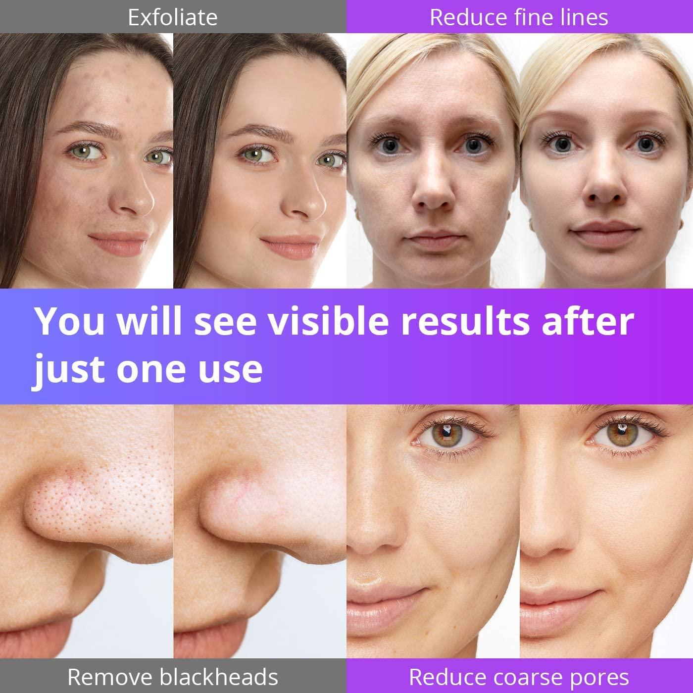 UNOISETION UNOISETION 3 in 1 Microdermabrasion Machine and Portable Dermabrasion Machine for Home and Travel