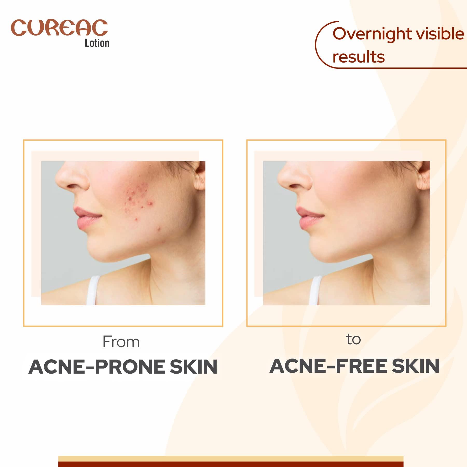 Salve Salve Acne Drying Lotion (70 ml (Pack of 2))