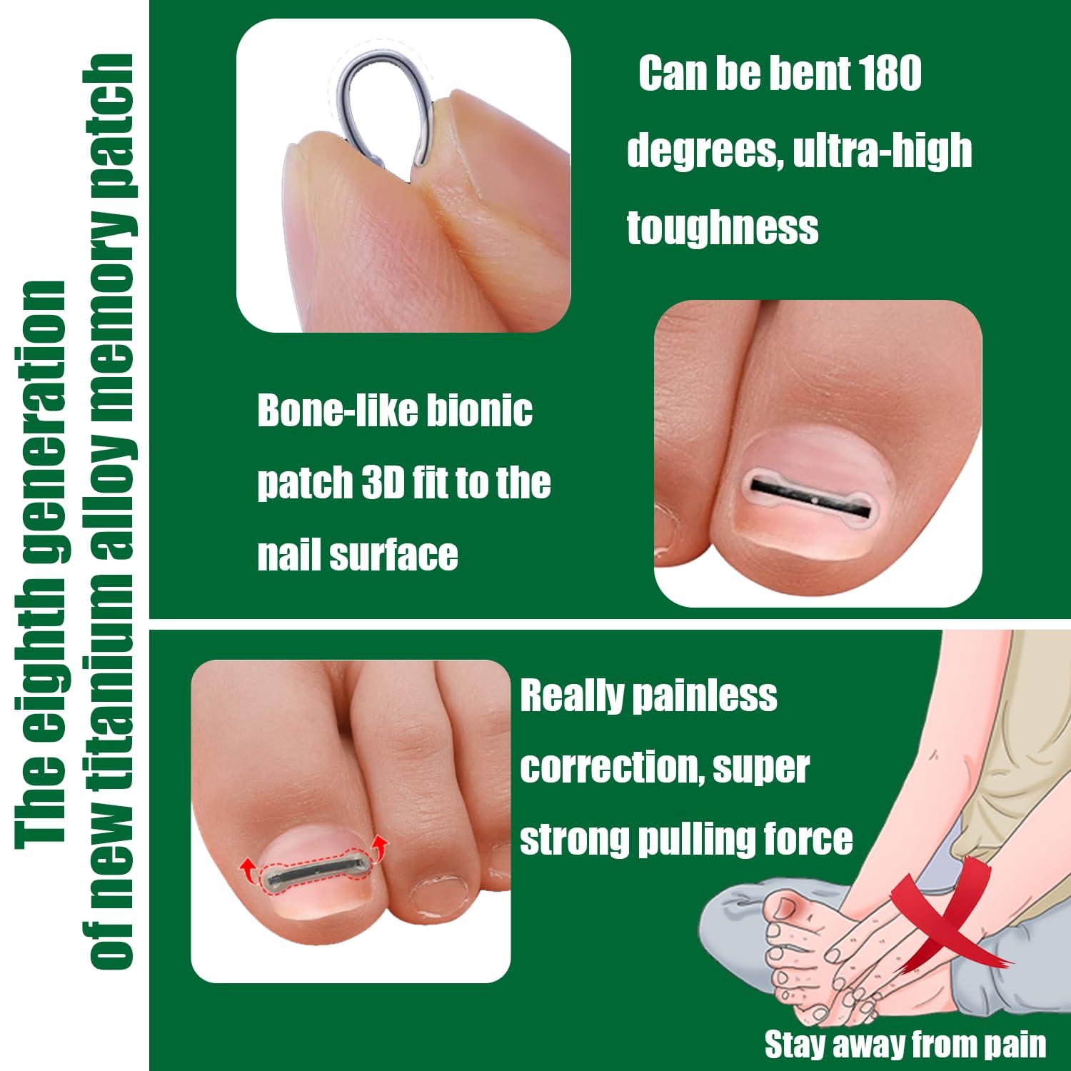 Truine Titanium Ingrown Toenail Corrector,Nail repair tools,Ingrown Toenail Treatment,Suitable for most people with ingrown toenailsIngrown Toenail Removal Kit,- Designed for Ingrown Toenail Repair10pcs