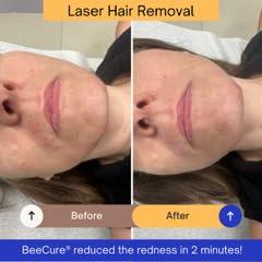 BeeCure BeeCure Radiation Relief and Laser Burn Cream Skin Care Cream, Burn Relief Cream with Buckwheat Honey & Calendula, 60ml Tube