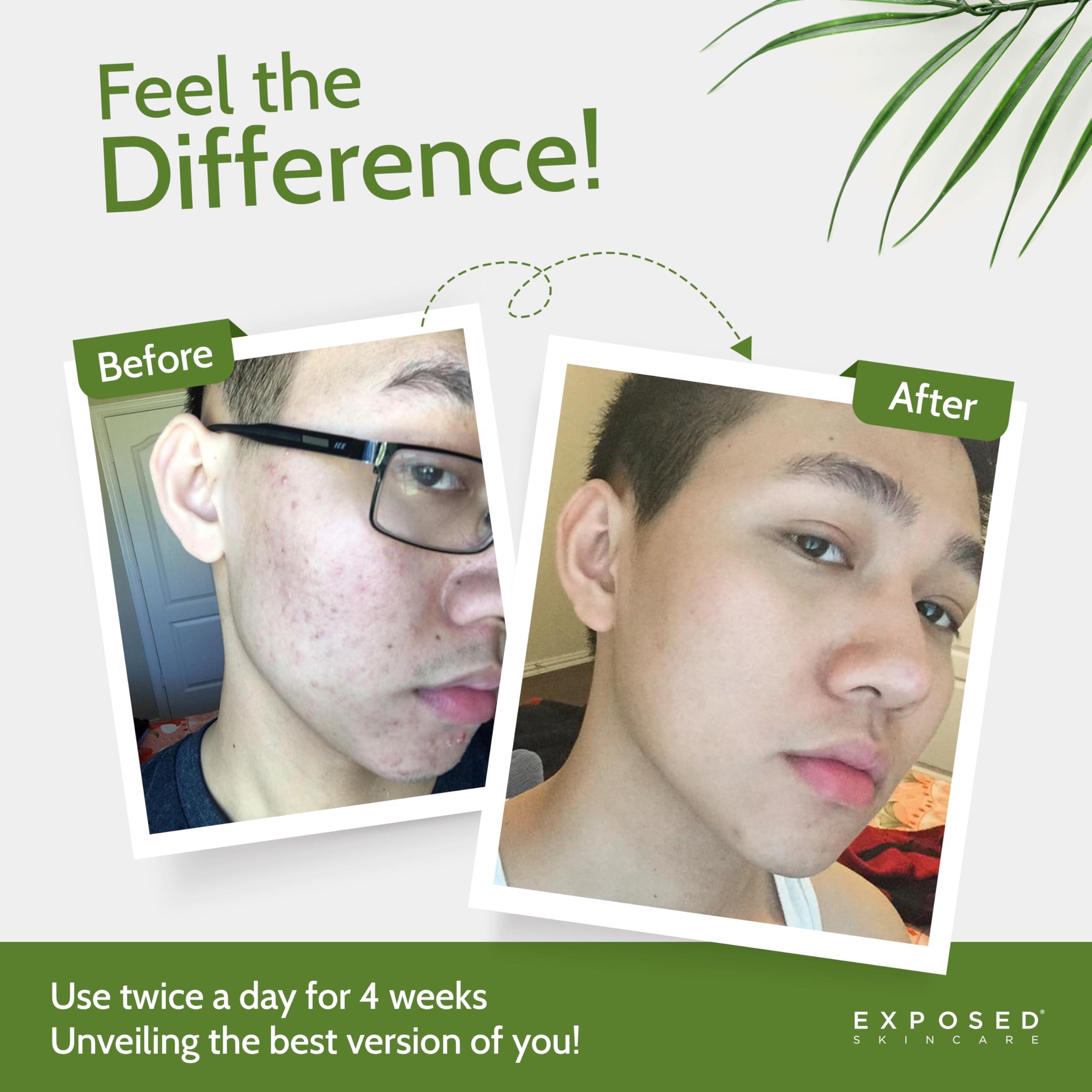 Exposed Skin Care Exposed Skin Care Expanded Acne Treatment Kit - Includes Salicylic Acid Face Wash, Clearing Tonic, Treatment Serum with Benzoyl Peroxide, Clear Pore Serum, Moisture Complex - Made for All Skin Types