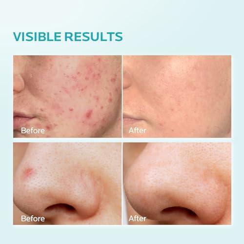 ZealSea ZealSea 10% Azelaic Acid Facial Cream - Azelaic Acid Serum with AHA for Face, Relief Pimple, Breakouts, Blackhead & Redness, Azelaic Acid Gel Clarify Skin Soothe Irritation, 0.34 Oz Travel Size