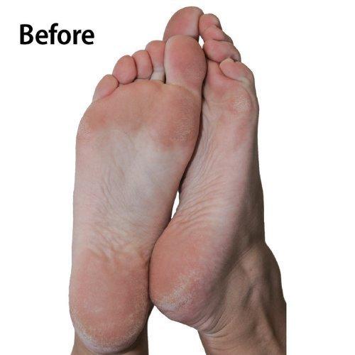 Emjoi Emjoi Micro-Pedi Nano Pro Callus Remover w/Manicure Kit & Extra Rollers (Burgundy)