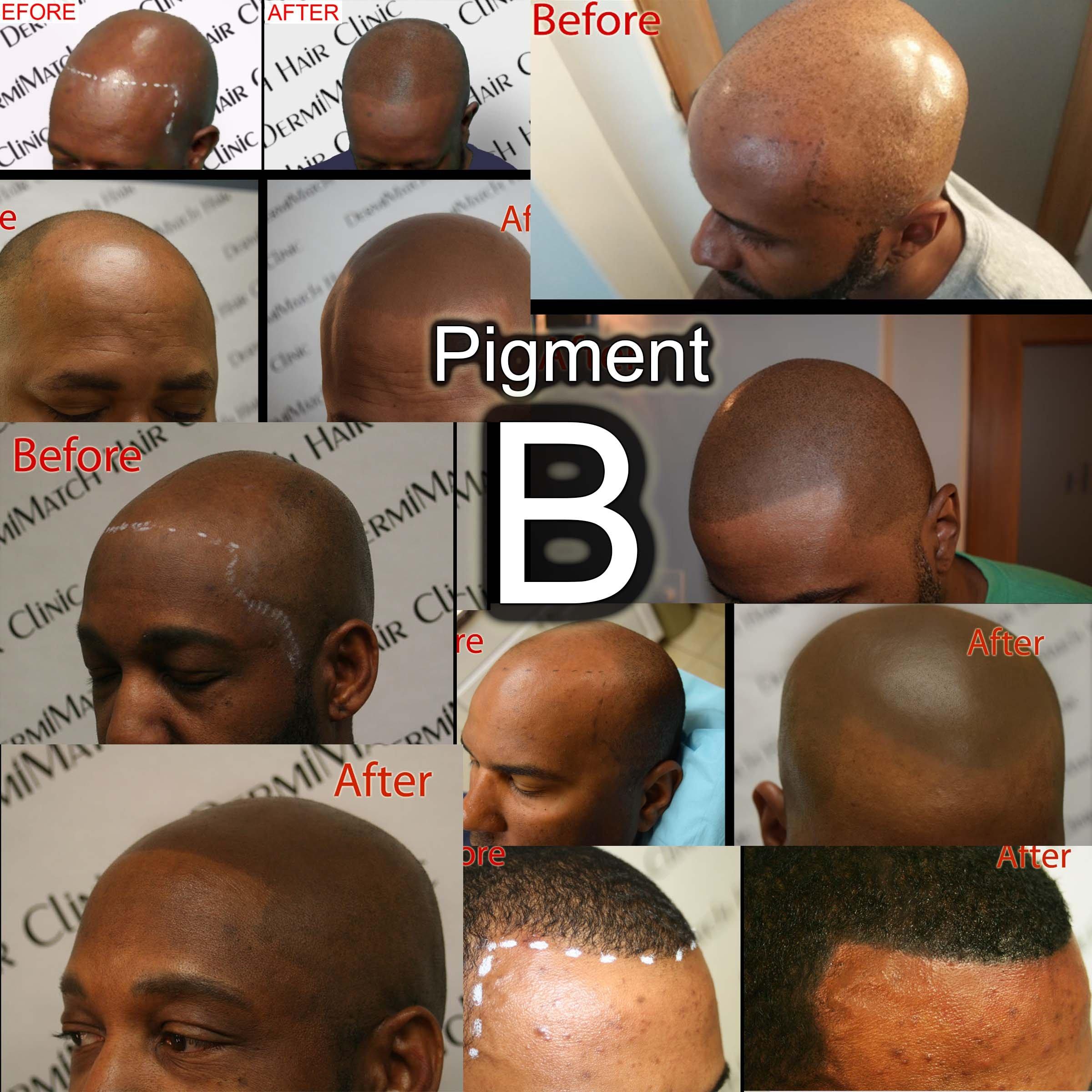 DermiMatch LLC B - Scalp micropigmentation pigments by DermMicro (B)