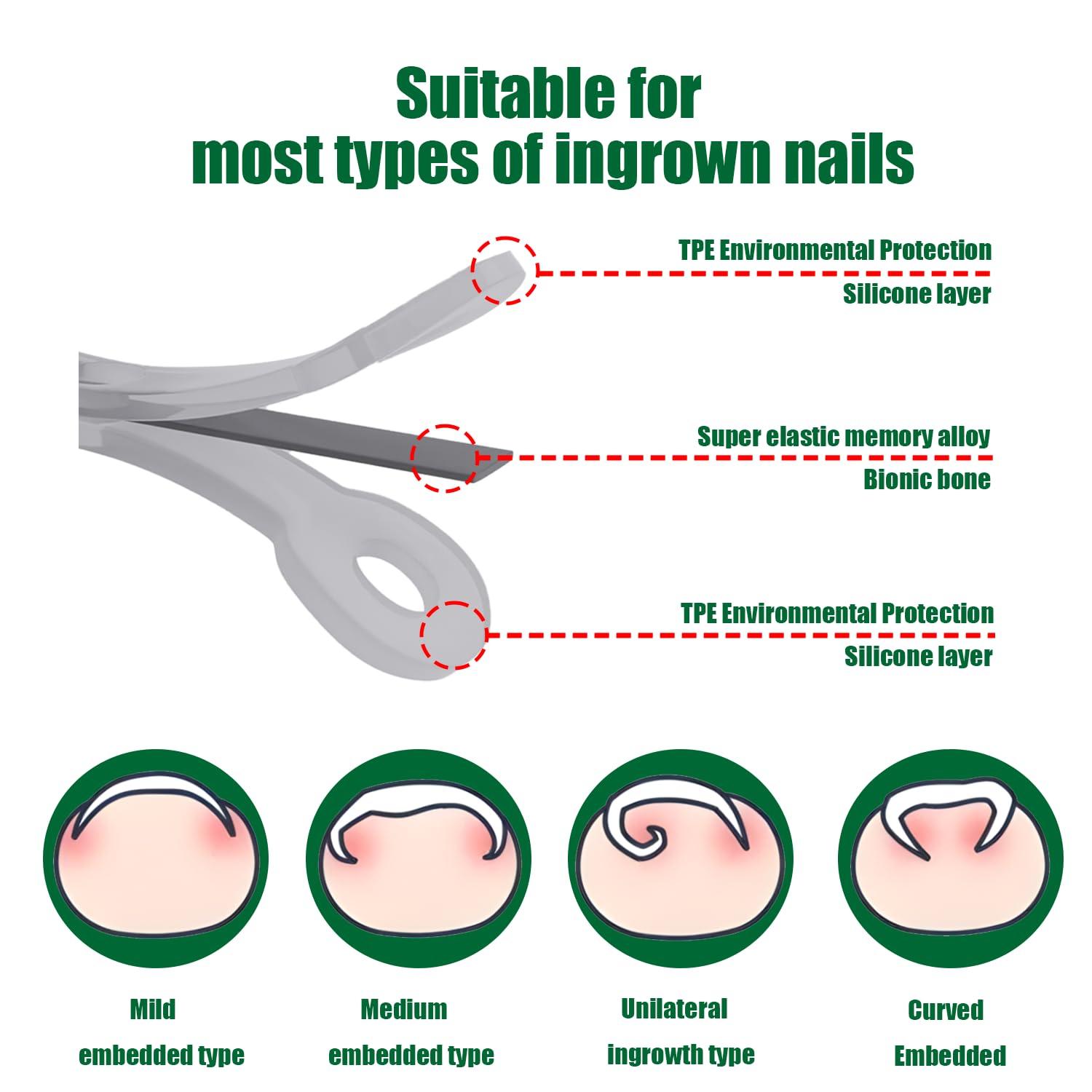 Truine Titanium Ingrown Toenail Corrector,Nail repair tools,Ingrown Toenail Treatment,Suitable for most people with ingrown toenailsIngrown Toenail Removal Kit,- Designed for Ingrown Toenail Repair10pcs