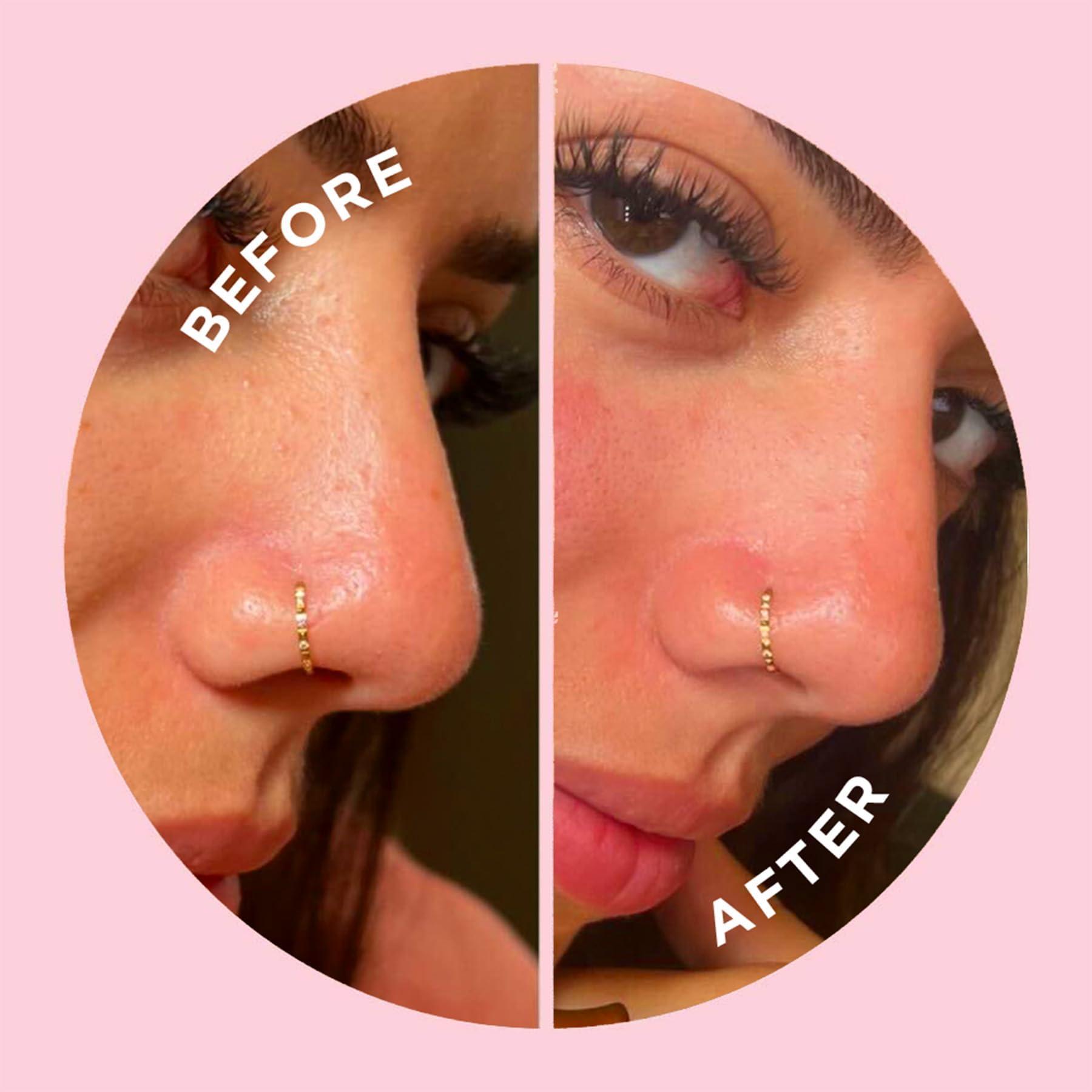 ZitSticka ZitSticka Hydrocolloid Surface Area Pimple Patches for Face - Clarifying Pore & Blemish for Large Zit T-Zone Coverage - Zit Sticker Absorbs Oil, Unclogs Pores, & Targets Clusters (NOSE PACK 8PC)