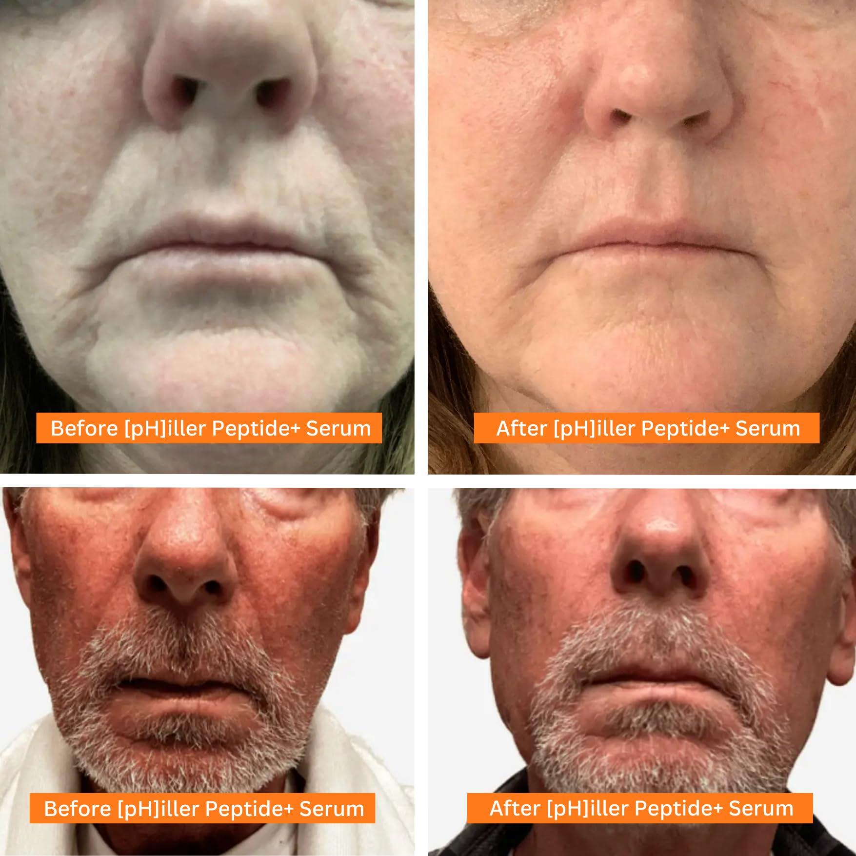 THE PHIX The PHIX pHiller Peptide Serum - Advanced Anti Aging Face Tightening Serum for Fine Lines and Wrinkles, Hydrating Peptides Facial Formula for Skin, with Argireline + Tripeptides; Vegan (1oz)