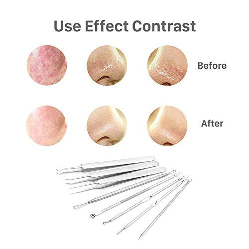 Pinkiou Pinkiou Blackhead Removers Comedone Pimple Popper Tool Acne Extractors Blemish Remover Ingrown Hair Tweezers Removal Kit Whitehead Remover Zit Treatment Skincare Tools for Face Nose, 8-in-1