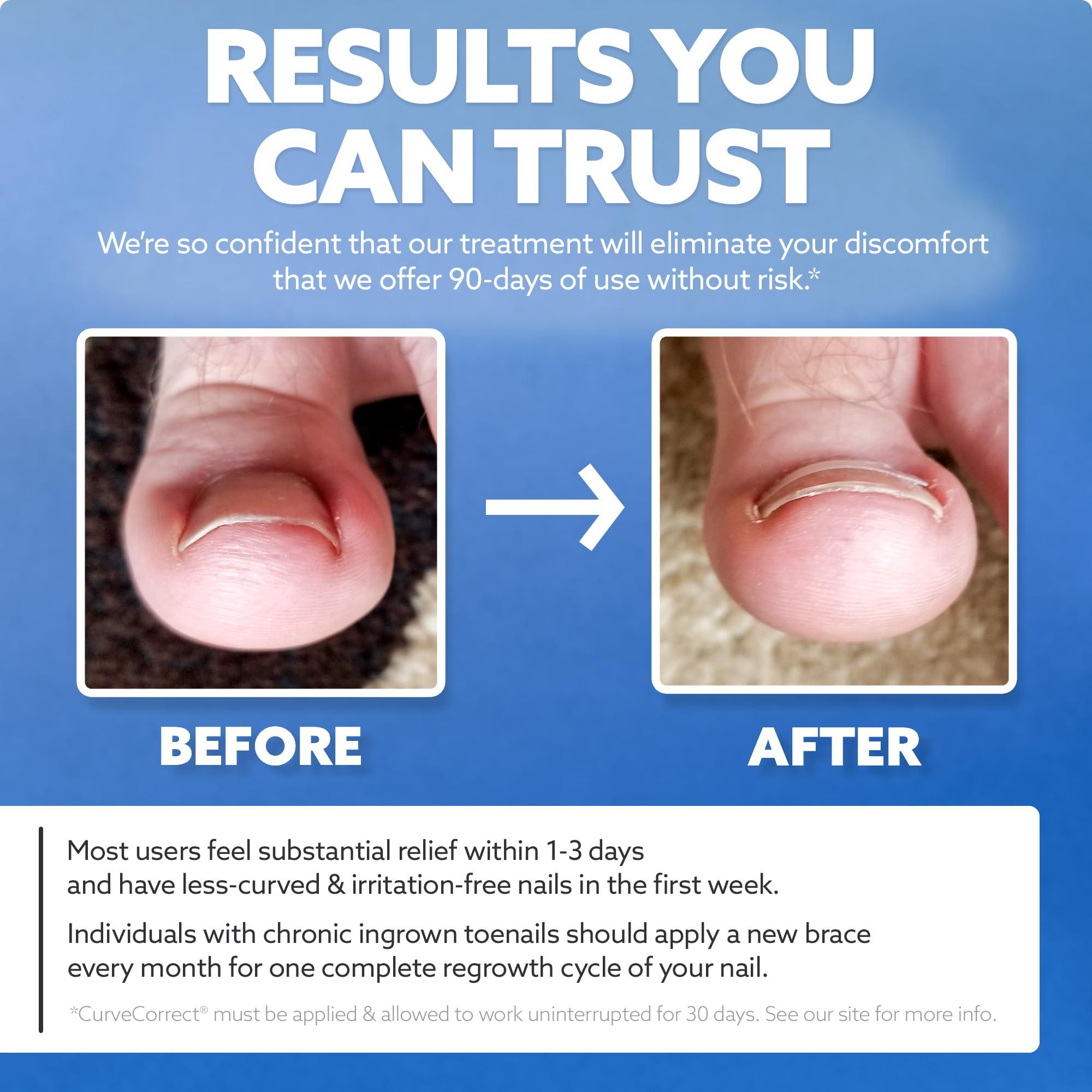 CurveCorrect CurveCorrect Ingrown Toenail Home Treatment | Ingrown toenail Correction kit, Includes Ten Standard Big Toe Nail Braces.