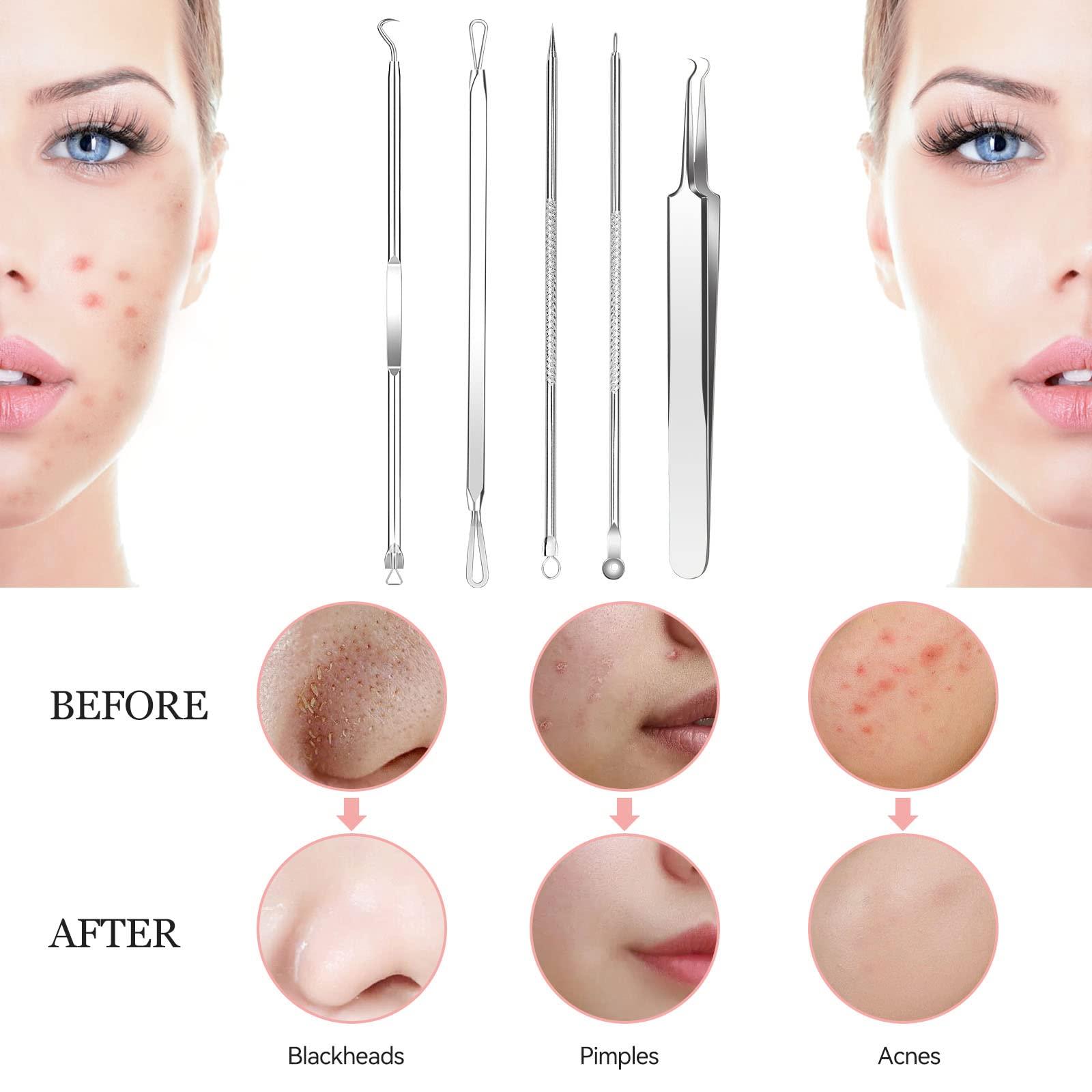 ritarga Blackhead Remover 8PCS Stainless Steel Pimple Popper Tool Kit with Portable Metal Case Whitehead Blemish Removal Tool