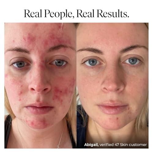 47 Skin 47 Skin Hydrating Face Serum for Clearing Acne & Scars, Anti-Blemish & Scar Repair Serum Skincare Treatment with Silver Chitoderm - Smooth Skin Moisturiser Facecare Serum for All Skin Types (1.01 oz)