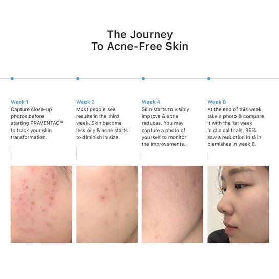 PRAVENTAC 60\'s Praventac Acne Treatment Remove Pimples Clogged Pores Blackheads Repair Skin Cells Dark Spots Whiteheads Backne