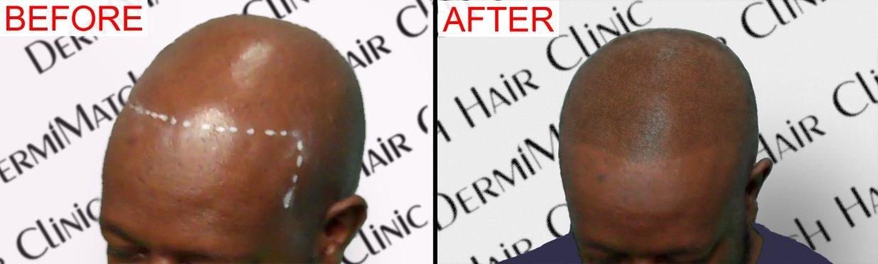 DermiMatch LLC B - Scalp micropigmentation pigments by DermMicro (B)