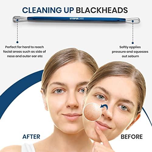 Utopia Care Utopia Care - Professional Blackhead and Blemish Remover - Pimple Comedone Removal 2-in-1 Extractor Tool - Spectrum Blue