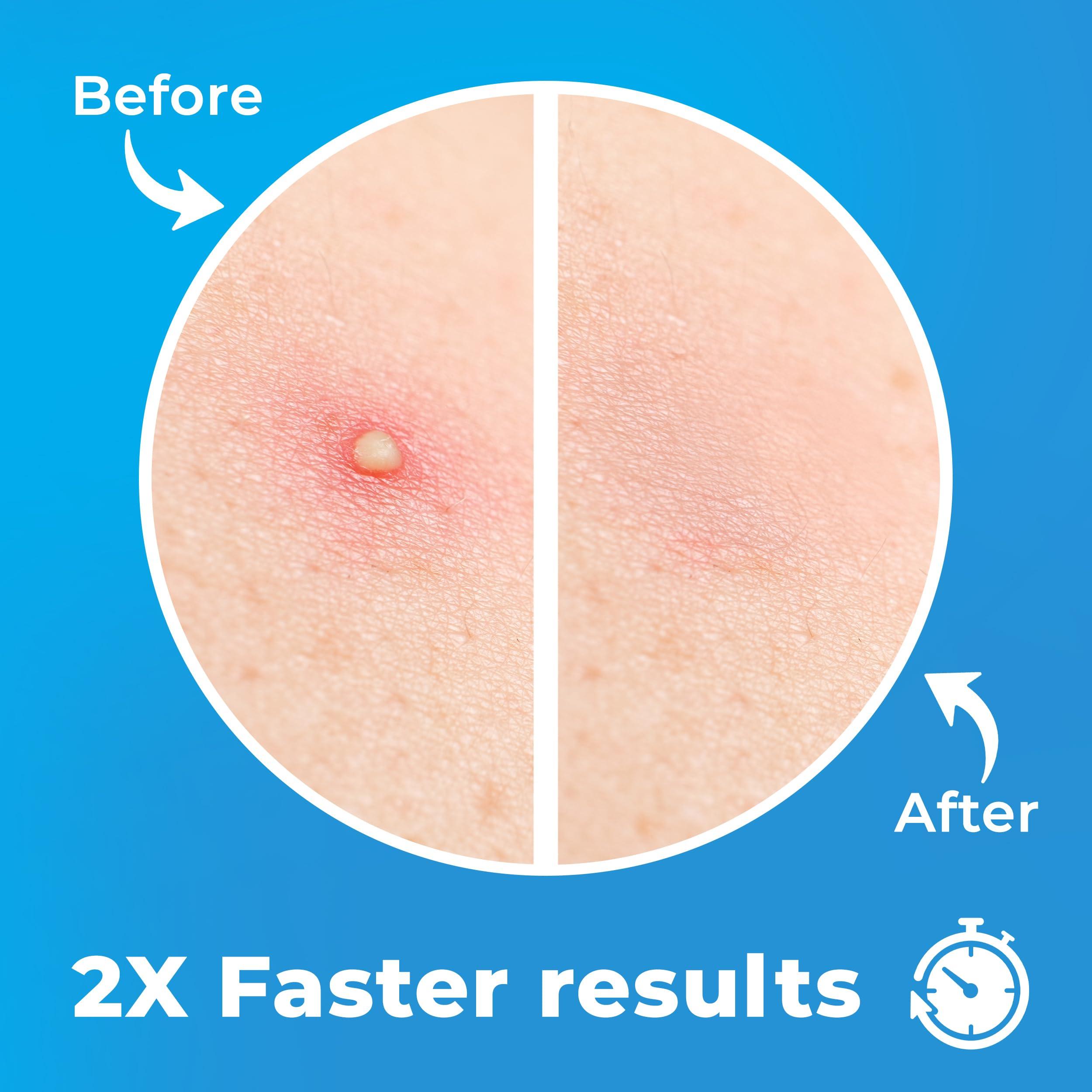KEYCONCEPTS PatchRx Pimple Patches for Face (120 Patches), Hydrocolloid Acne Patches with Tea Tree Oil, Pimple Patch Pimple Stickers - Hydrocolloid Patch Acne Dots - Acne Pimple Patches For Face - Zit Patches