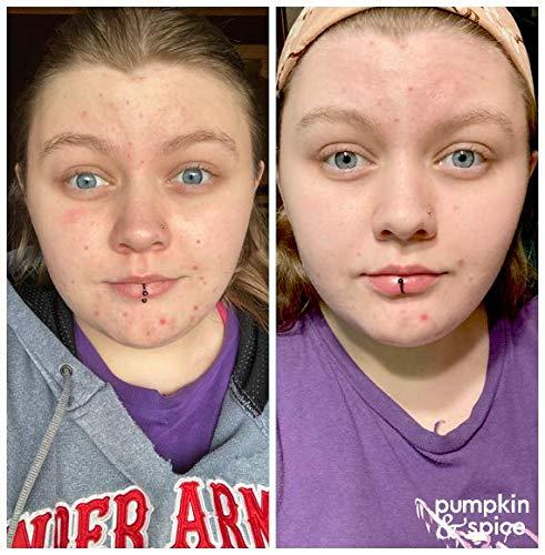 Pumpkin And Spice Pumpkin Spice Clay Enzyme Facial Mask | Removes Pimples, Minimizes Pores, Blackheads, Wrinkles, Breakouts | Hydrates, Tightens, Brightens | Organic Pumpkin Seed Oil Dermal Body Purifying | 50g