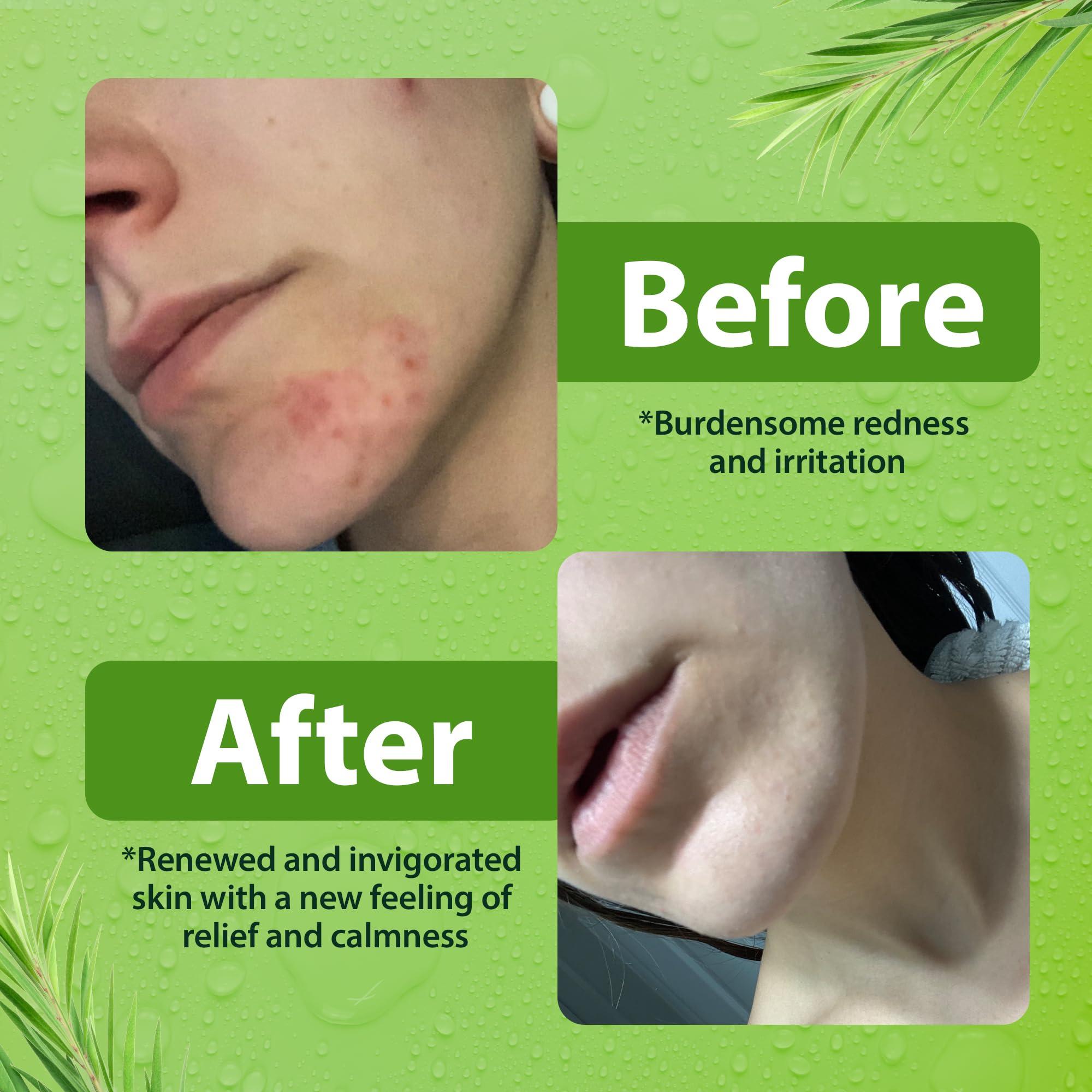 Derma-nu Miracle Skin Remedies Antibacterial Body Wash - Antibacterial Soap And Tea Tree Body Wash For Jock Itch, Athletes Foot, Eczema And Back Acne - Anti Bacterial Body Soap For Men And Women Safe For All Skin Types - 2 Pack