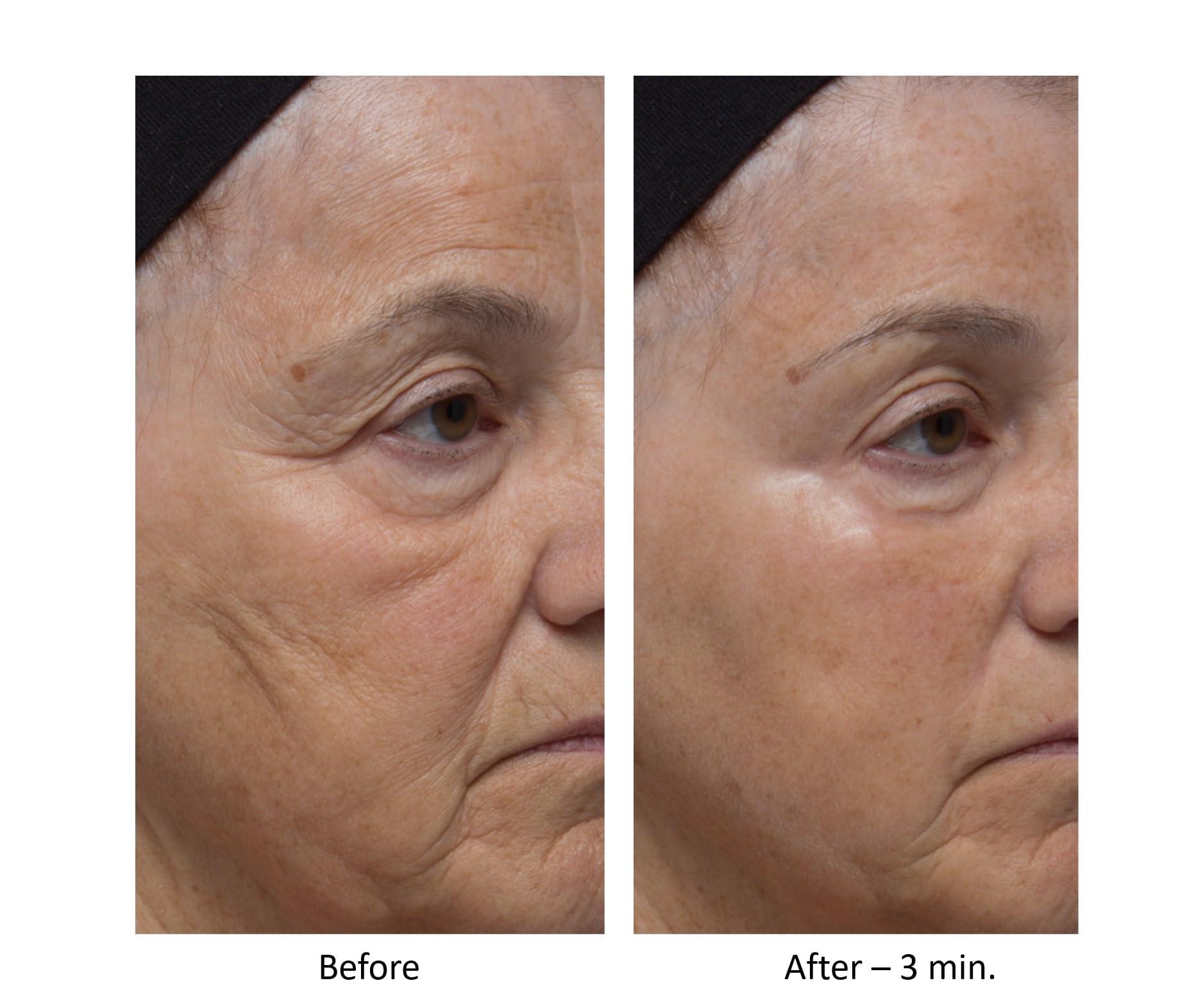 Dr. Denese Dr. Denese Wrinkle Lost Line Reducer, 3 Minute Age Eraser With Silk Protein Fiber Technology