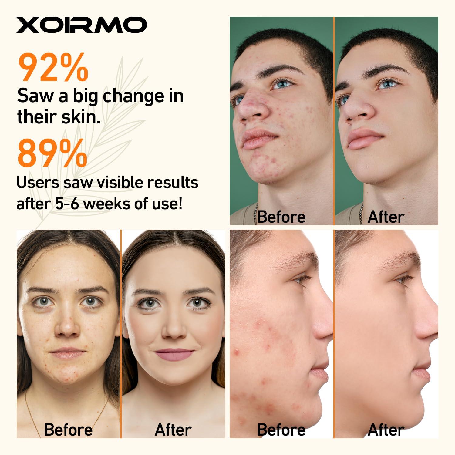 XOIRMO Blue Light Therapy Device for Acne Spot Treatment - XOIRMO LED Acne Blue Light Therapy Wand for Face