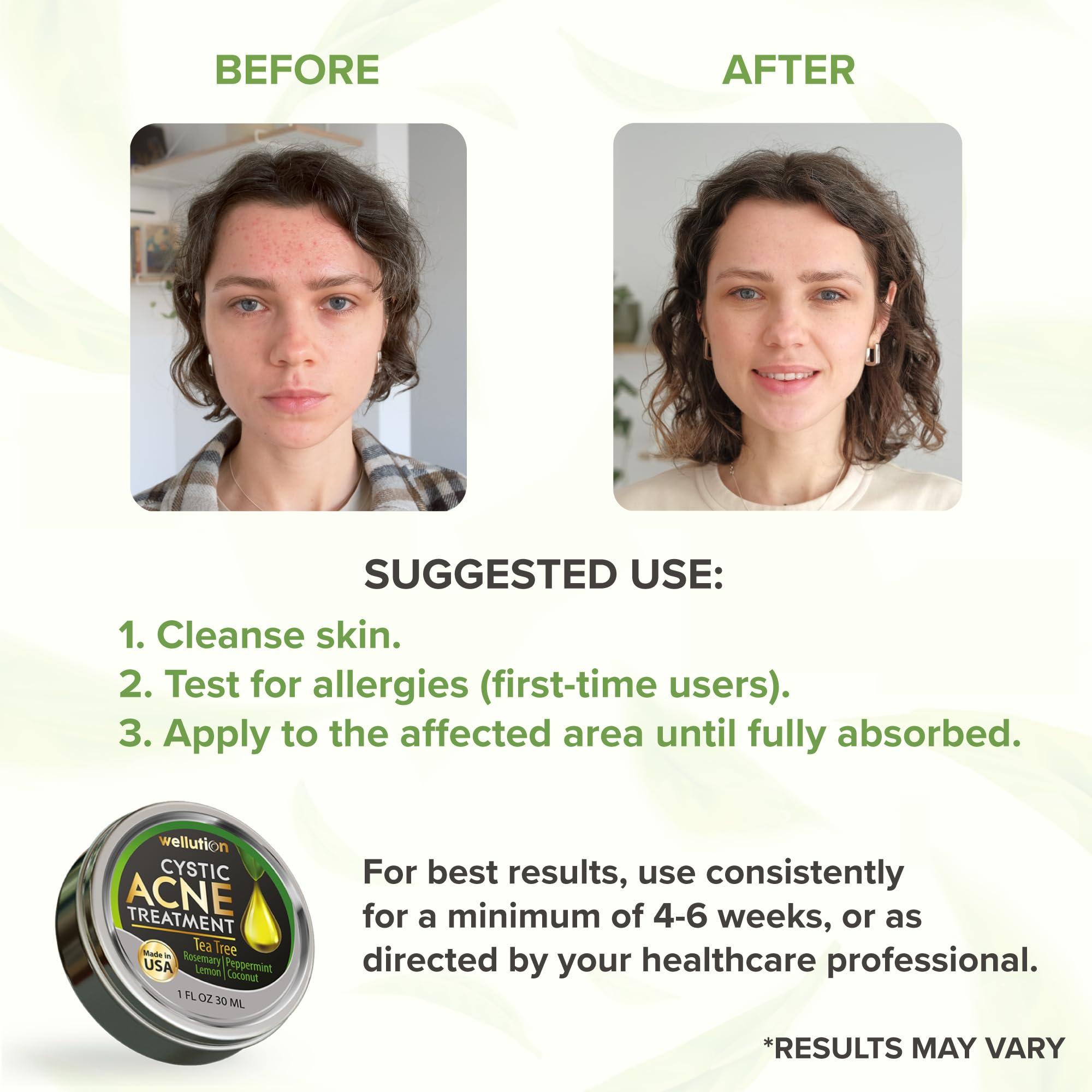 WELLUTION Wellution Cystic Acne Treatment Cream - Natural Pimple and Scar Remover with Tea Tree Oil - Effective Overnight Face Treatment for Acne Spots, Pimples and Scars - 1oz