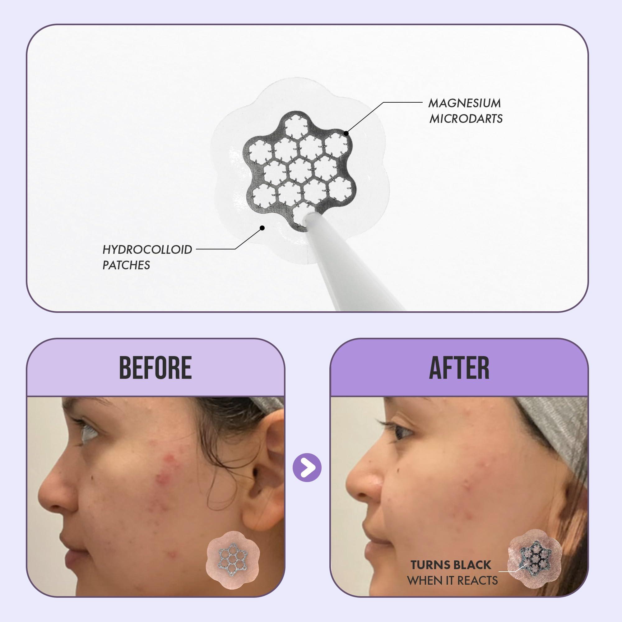FreeGo Deep Blemish Microdarts | Pimple Patch | Cystic Acne | Fast-Acting | Quick Calming | 99.9% Pure Magnesium | Madecassic Acid | Tea Tree | Eucalyptus Leaf | Hydrocolloid Spot Care