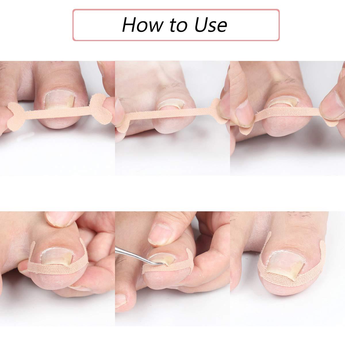 EBANKU EBANKU Ingrown Toenail Treatment Strips, 20 Pcs Toe Nail Correction Patch Elastic Patch Sticker Corrector Pedicure Tools Fingernail Toe Nail Care