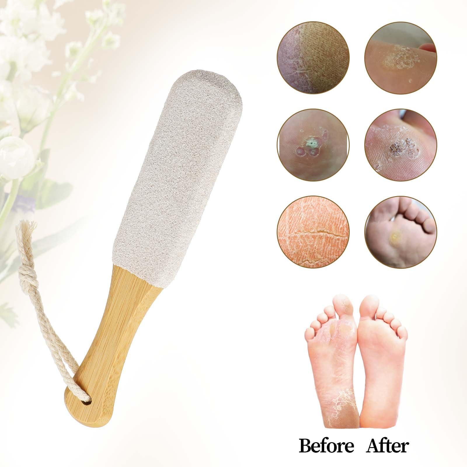 WY LIGHTING LEVEL Callus Remover Foot Scrubber Foot File Foot Care & Foot Exfoliator Foot Rasp Pedicure Tools Pumice Stone for Feet Remove Corn Hard Skin Dead Skin Cracked Heel for Shower Hand Body Foot Scraper Wet Dry