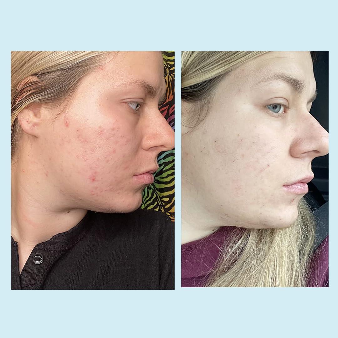 Perfect Image Salicylic Gel Chemical Peel - Enhanced with Green Tea Extract and Tea Tree Oil (20% Strength)