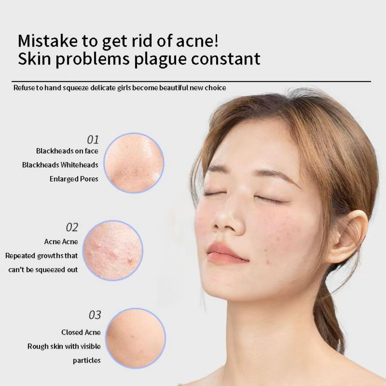 Mrchrogge Mrchrogge Facial Blackhead Remover Tweezers,Stainless Steel Portable Acne Needle Double Head,Squeeze Pick Acne Blackhead Needle Acne Needle Acne Needle (Pink)