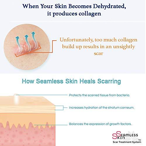 Seamless Skin SEAMLESS SKIN Scar Removal Treatment System (Set of 2) Silicone Gel Sheets - Mastopexy Areopexy Recovery - Breast Anchor Lift For Post Op Surgery & Stretch Marks Reducer