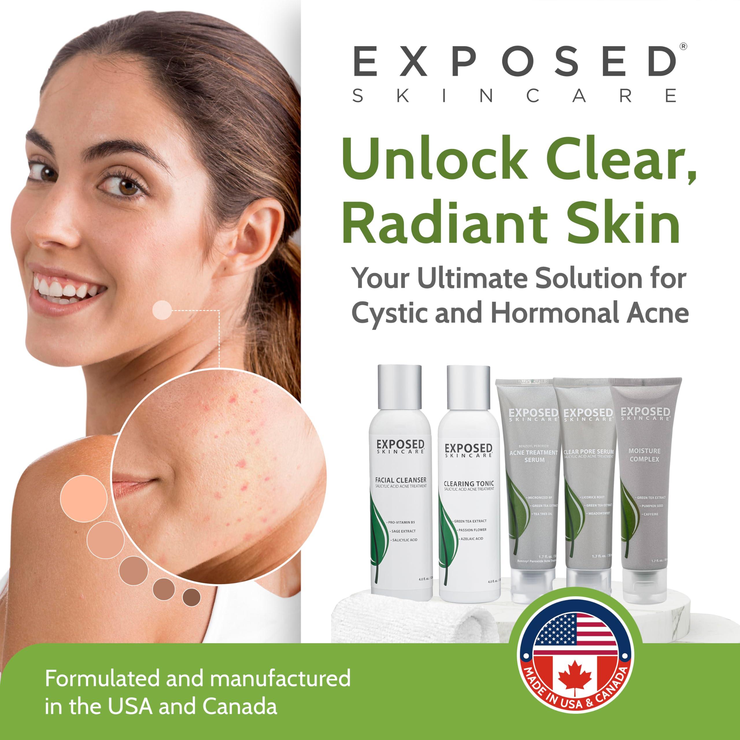 Exposed Skin Care Exposed Skin Care Expanded Acne Treatment Kit - Includes Salicylic Acid Face Wash, Clearing Tonic, Treatment Serum with Benzoyl Peroxide, Clear Pore Serum, Moisture Complex - Made for All Skin Types