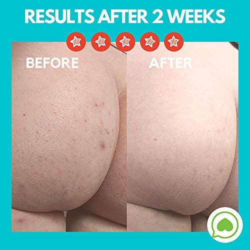 Green Heart Labs Brilliant Booty Kit | Butt Acne Clearing Lotion and ExfoliMATE Magic Body Exfoliating Cloth for Soft & Young Skin (Black)