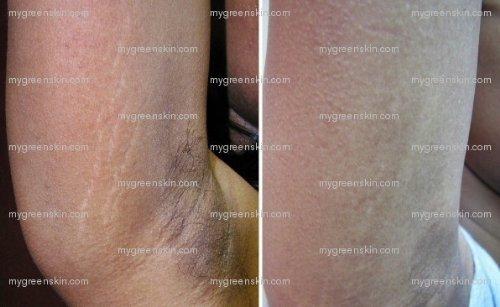 Green Skin Organix Best STRETCH MARK Complete Solution Kit- Medical grade microdermabrasion crystals mixed with Raw Cocoa Butter +organic 15 natural oils blend Stretch Mark COMPLETE KIT Microdermabrasion Crystal Butter & Green15 Oil shown to prevent and remove old stre