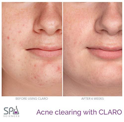SPA SCIENCES Spa Sciences CLARO Clinically Proven Blue & Red LED Acne Treatment Light Therapy System-FDA Cleared-Rechargeable- Professional Home Acne Healing/Clearing Treatment